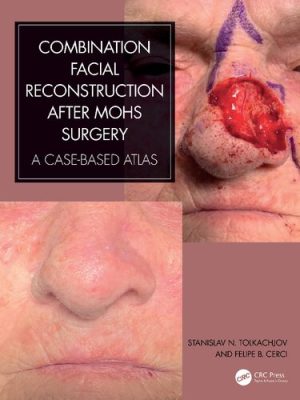 Combination Facial Reconstruction after Mohs Surgery A Case Based Atlas
