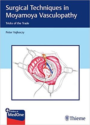 Surgical Techniques in Moyamoya Vasculopathy Tricks of the Trade