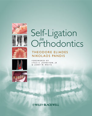 Self Ligation in Orthodontics