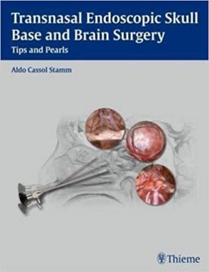 Transnasal Endoscopic Skull Base and Brain Surgery Tips and Pearls